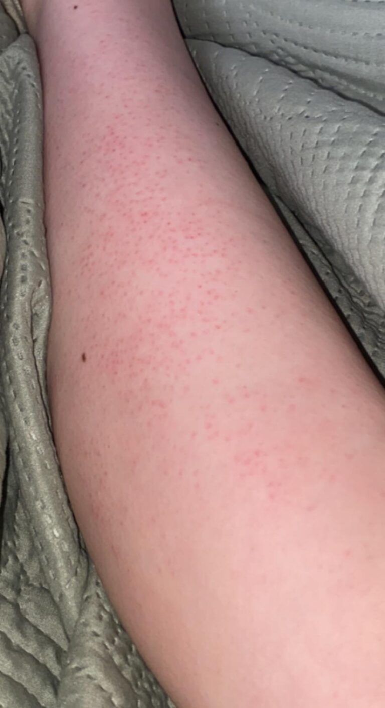 Red Bumps After Using Hair Removal Cream