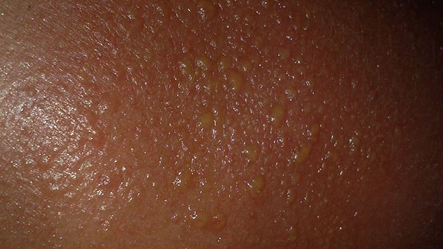 What Causes Pimples After A Sunburn?